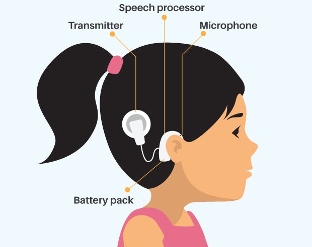 Cochlear Implant