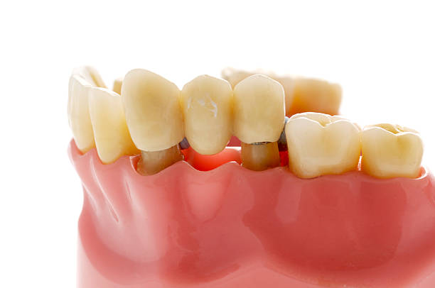 What is a dental bridge? Complete guide on bridges