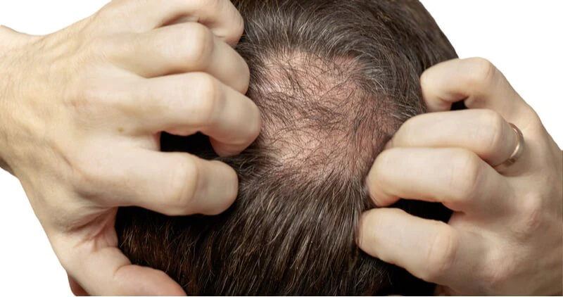 laser_hair_loss_treatment_for_males